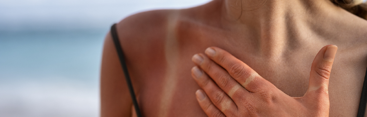 Auswirkungen hat ein Sonnenbrand auf unsere Haut