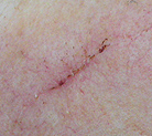 2 Wochen nach der Operation